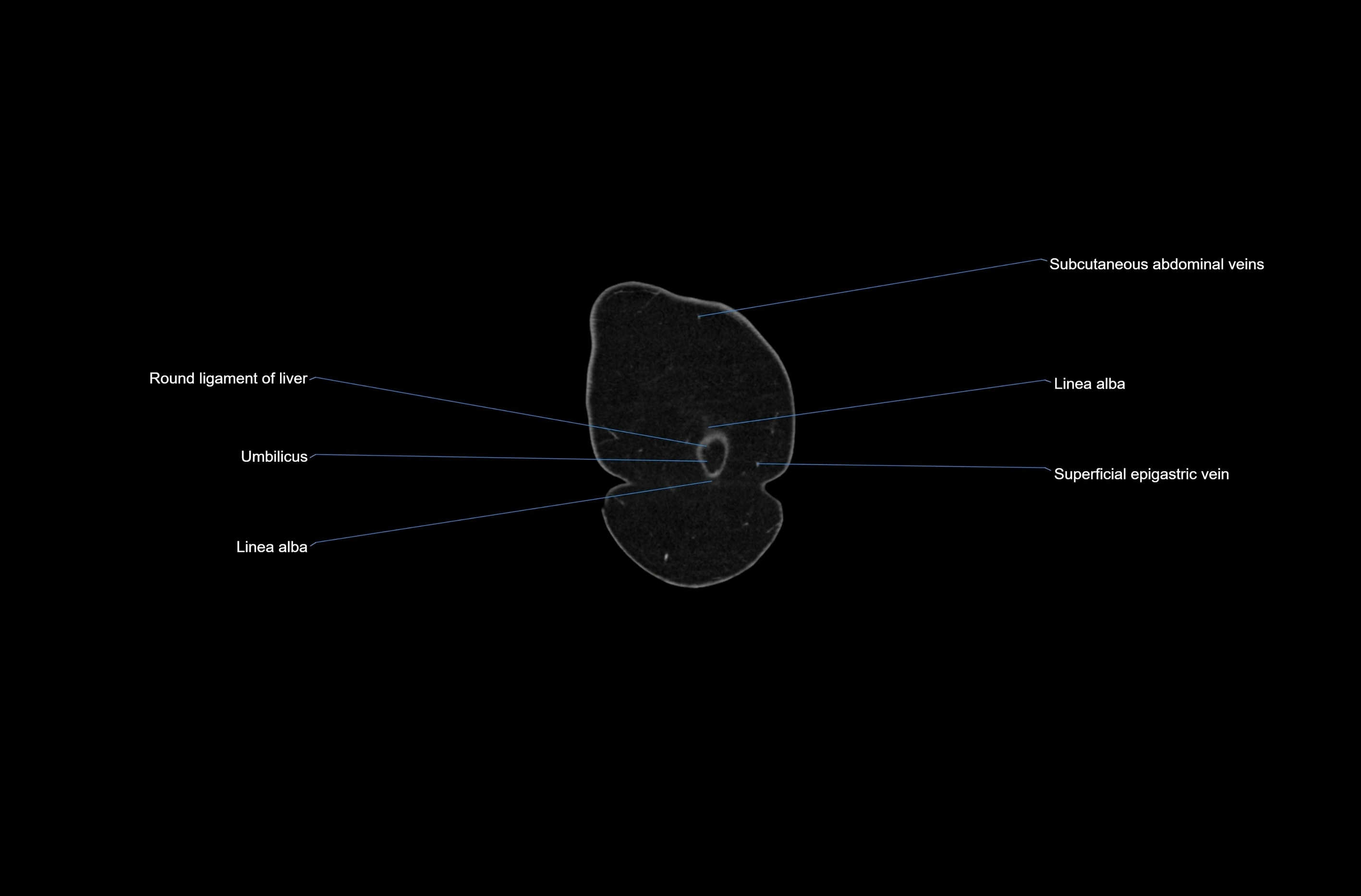 CT abdomen coronal cross sectional anatomy labelled radiology image-00002.webp